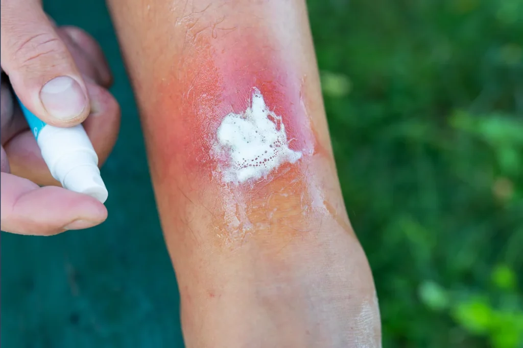 Une personne qui soigne une brulure