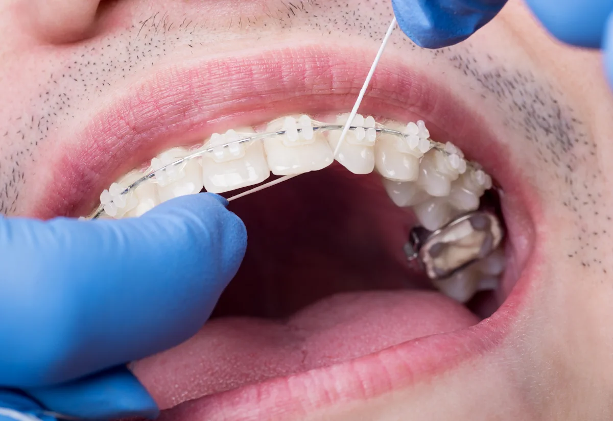 Une personne qui passe un fil dentaire entre des dents avec des bagues